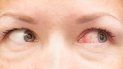 omicron: ¿cual es el sintoma detectable en los ojos?