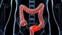 cancer de colon: como reconocer los sintomas